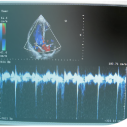 Ecografía doppler-dúplex en los accesos vasculares para hemodiálisis