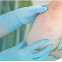 Cuidado de la piel, tratamiento tópico y calidad de vida en psoriasis