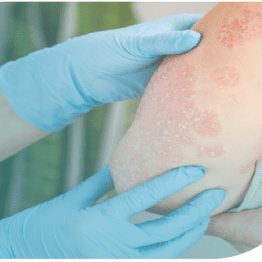 Cuidado de la piel, tratamiento tópico y calidad de vida en psoriasis