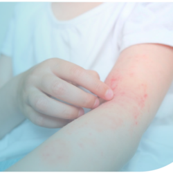 Actualización en dermatitis atópica