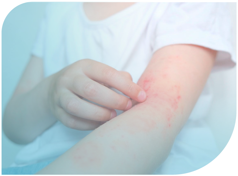 Actualización en dermatitis atópica