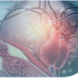 Enfermedad cardiovascular en superviviente al cáncer