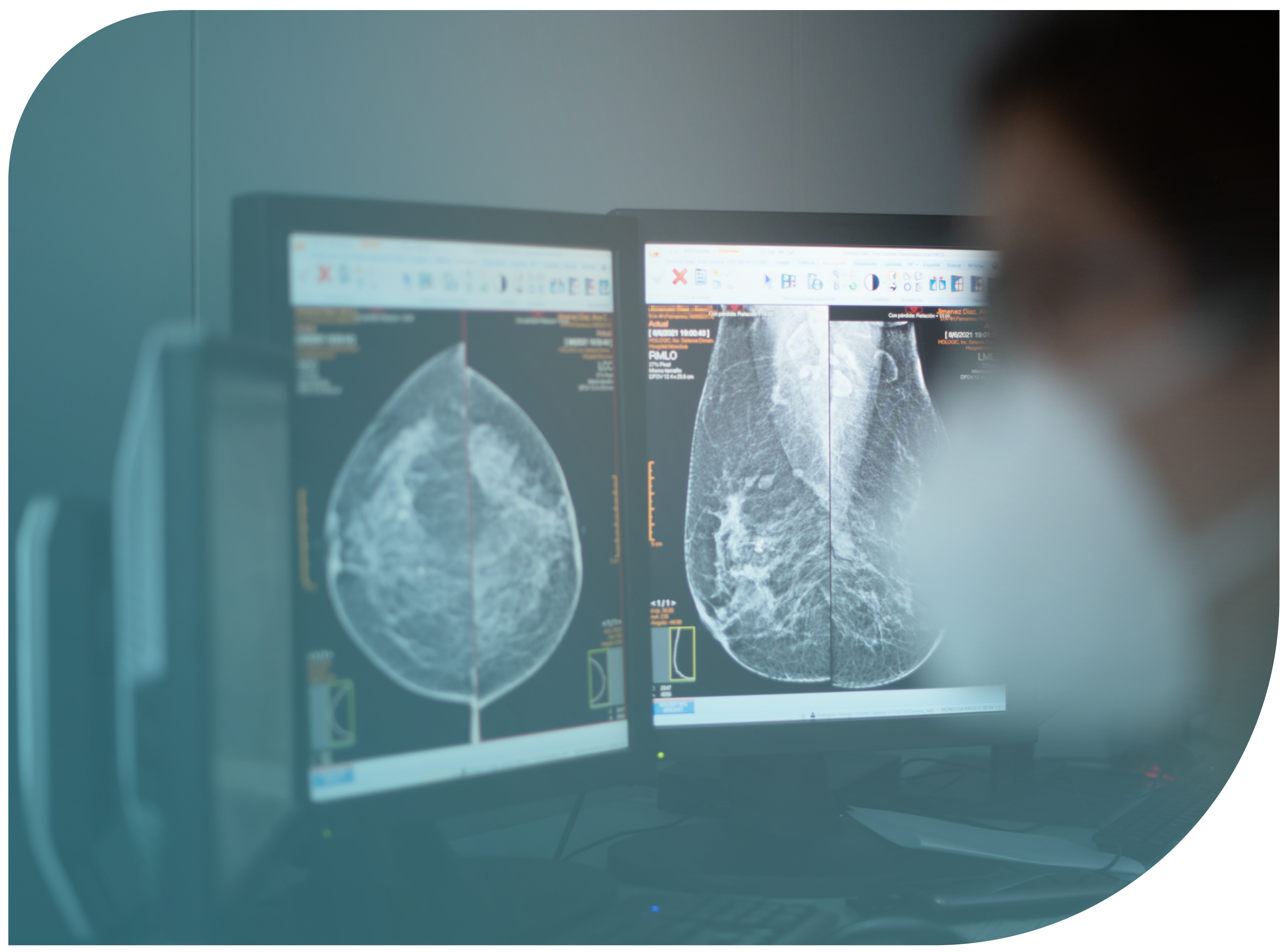 Aspectos diagnósticos radiológicos del cáncer de mama: diagnóstico, herramientas, clasificación TNM