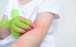 La incidencia de la dermatitis atópica ha aumentado entre 2 y 3 veces en los últimos treinta años