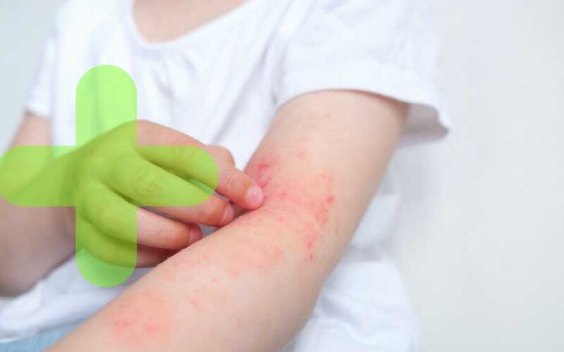 La incidencia de la dermatitis atópica ha aumentado entre 2 y 3 veces en los últimos treinta años